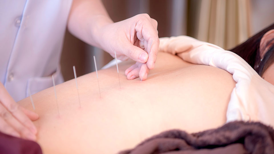 drd-The-Science-(And-Common-Sense)-Of-Acupuncture Close up on practitioner applying acupuncture needles along someone's spine
